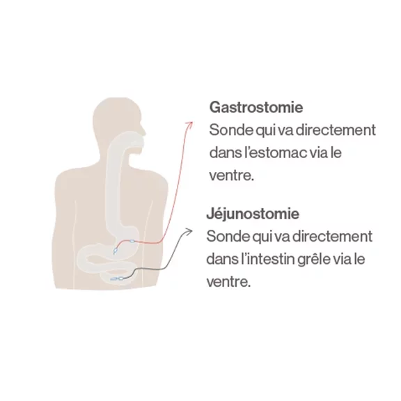 sonde gastrotomie