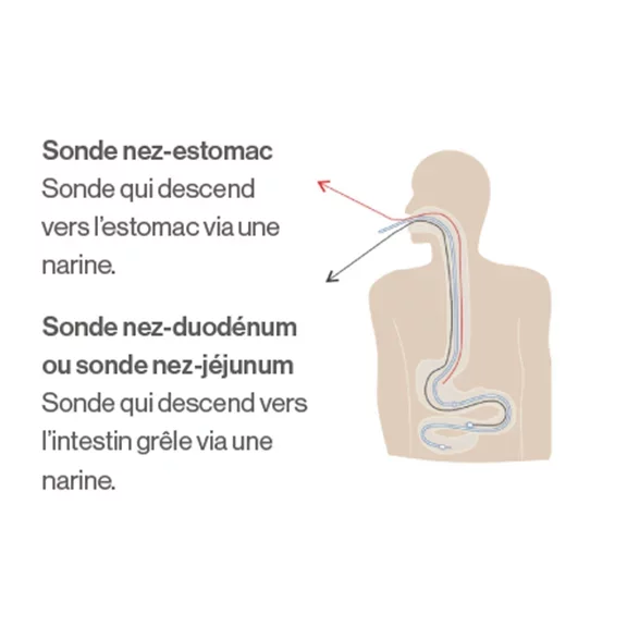 sonde naso-gastrique