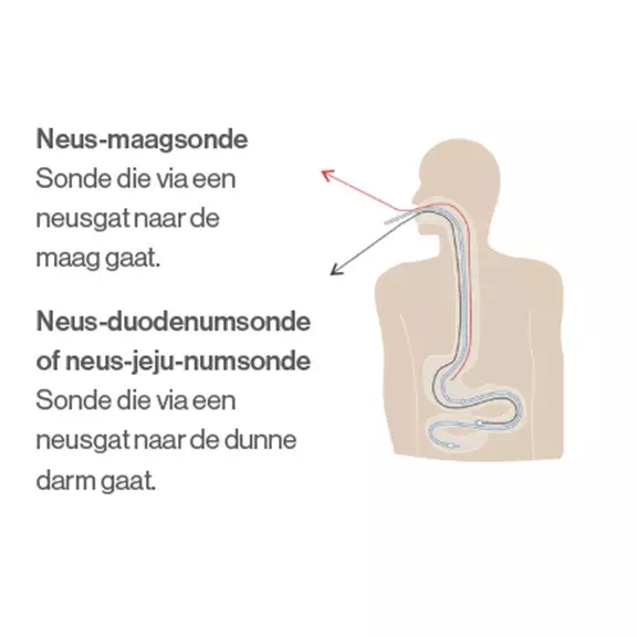 NG-sonde