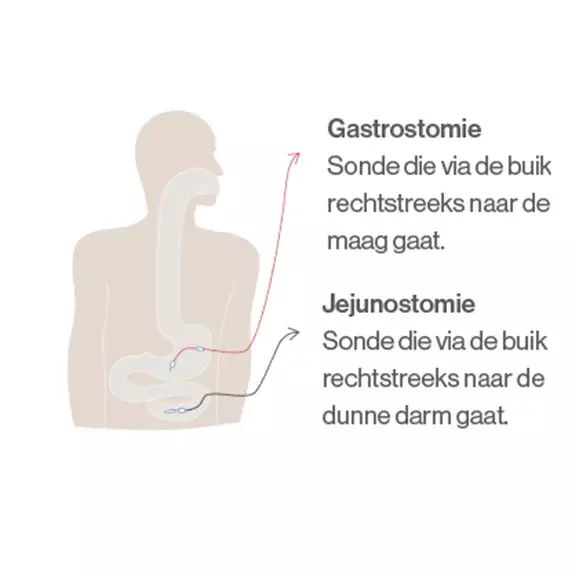 Gastrostomie sonde