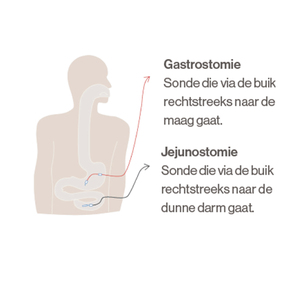 Gastrostomie sonde